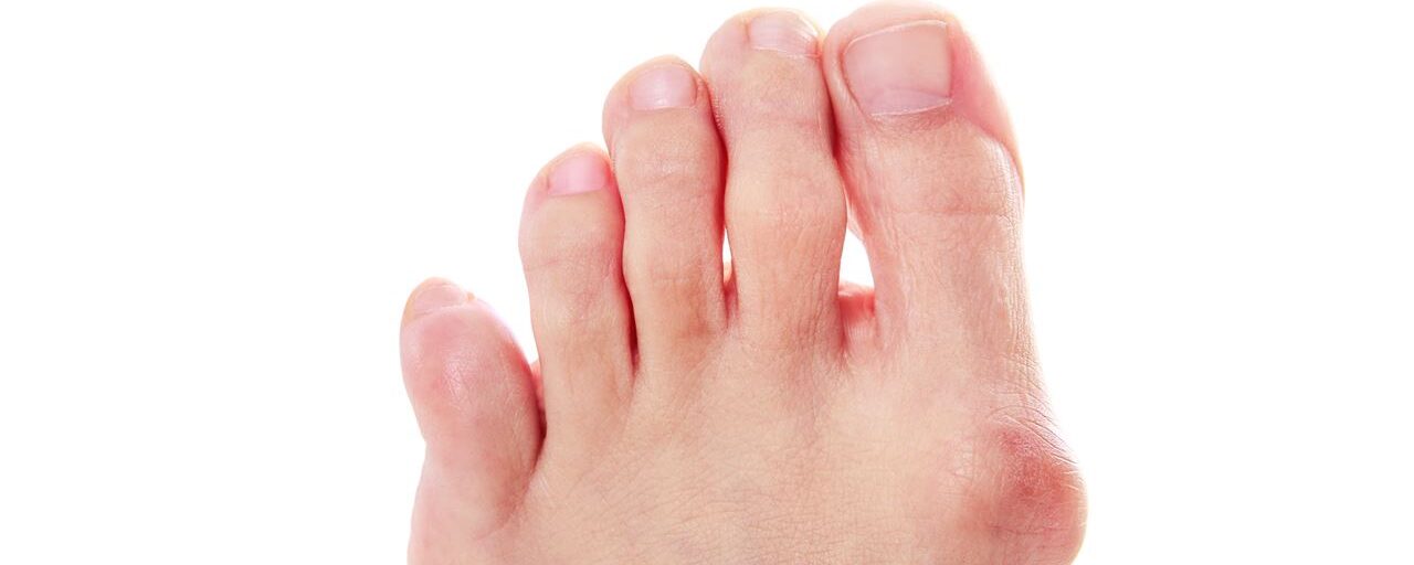 Hallux valgus