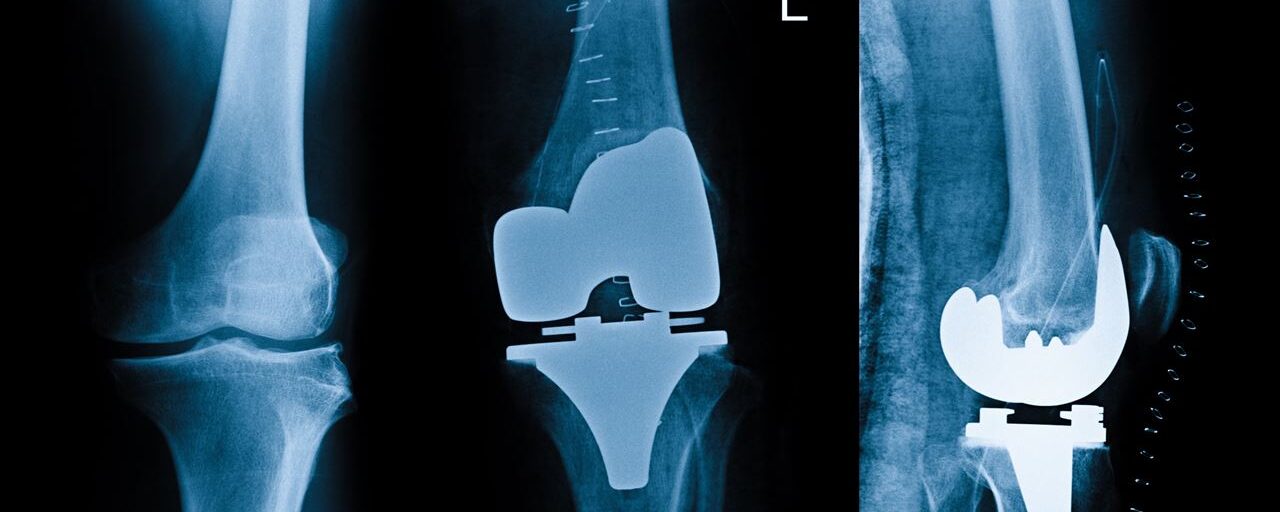 Wat komt er kijken bij een nieuwe heup, knie of schouder?